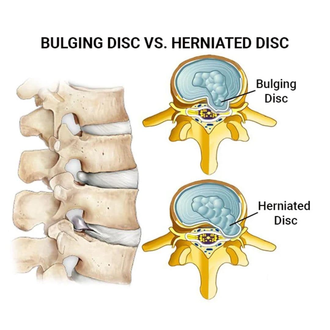 Disc bulge vs herniation