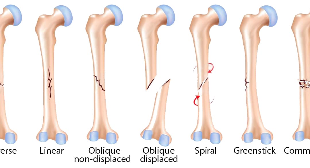 Types of bone fractures
