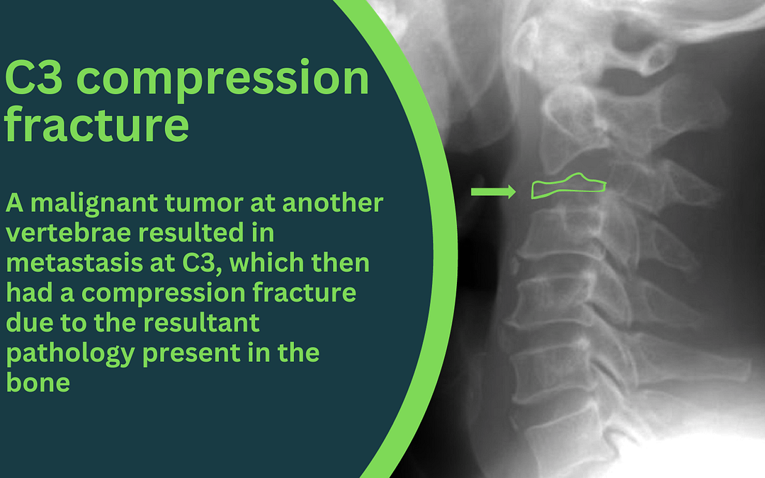 C3 cervical vertebra compression fracture diagram as uncommon neck pain source