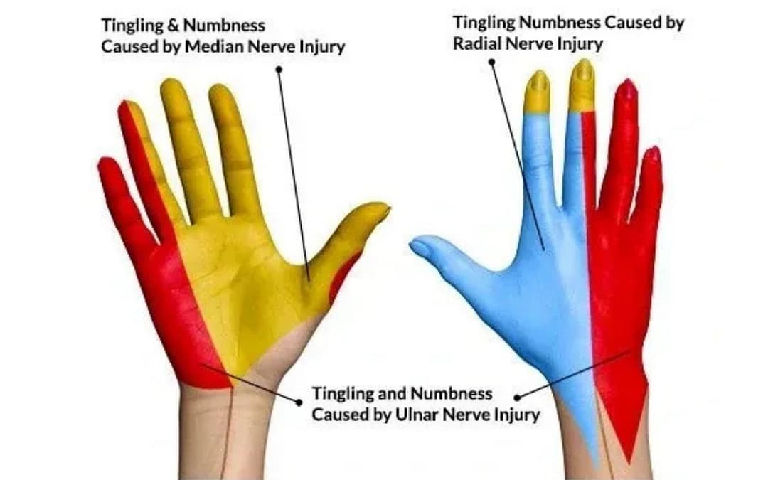 Hand numbness patterns diagram comparing carpal tunnel and Tunnel of Guyon syndrome