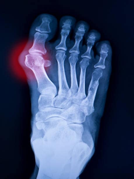 gout title