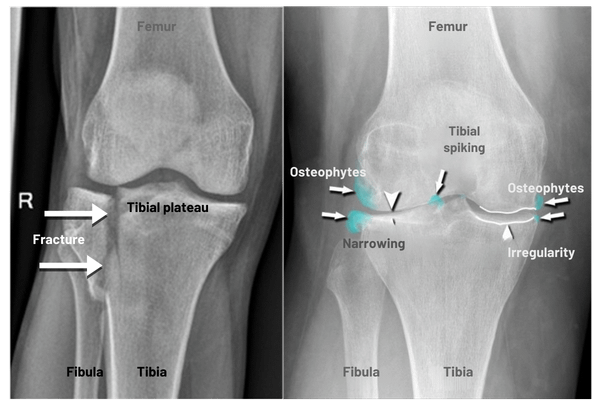 X-ray showing tibial plateau fracture and knee osteoarthritis, highlighting the importance of chiropractic care for joint health