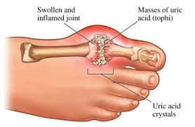 Gout symptoms illustration showing inflamed joint and uric acid crystal buildup