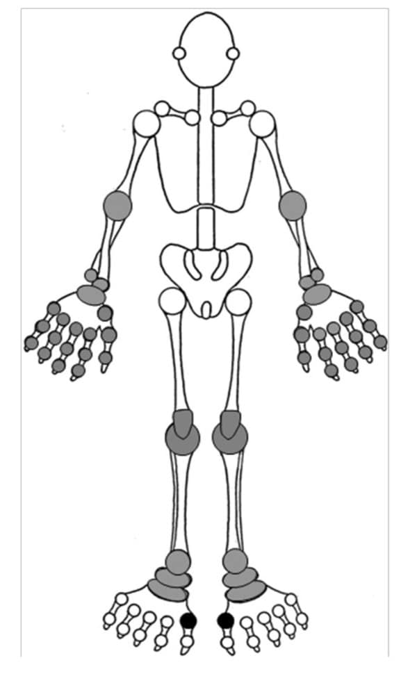 Gout joint involvement diagram showing affected areas in feet hands and knees