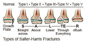 Salter harris fractures Salter-Harris fracture classification diagram showing types I through V in children