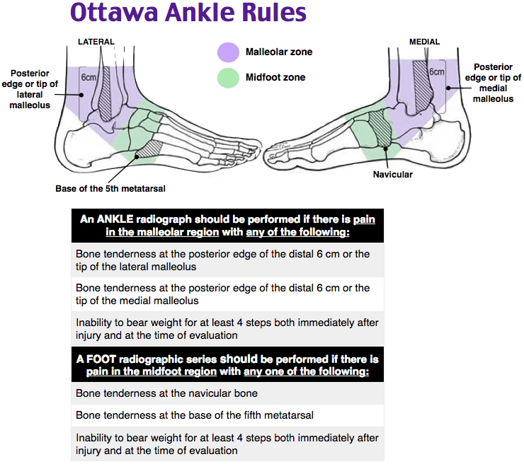 ottawa ankle rules 2 Ottawa ankle rules chart for assessing acute ankle injury severity on vacation