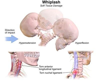 400px-Whiplash_Injuries Whiplash injury cervical spine anatomy diagram showing force and tissue damage