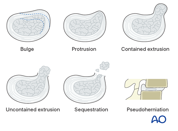 discs Lumbar intervertebral disc anatomy diagram illustrating types of disc injuries